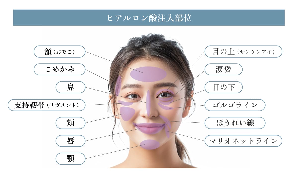 ヒアルロン酸注入部位