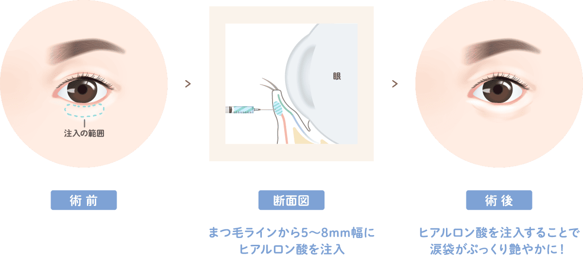 涙袋　ヒアルロン酸