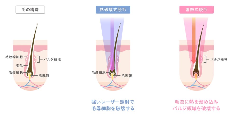 熱破壊式脱毛と蓄熱式脱毛