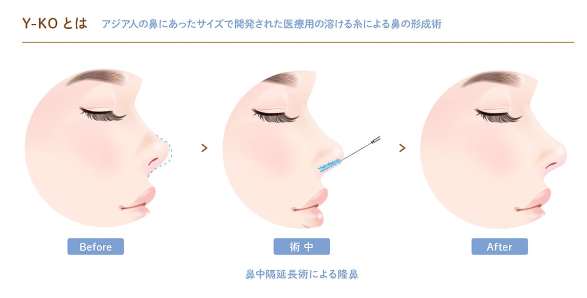 切らない鼻中隔延長術