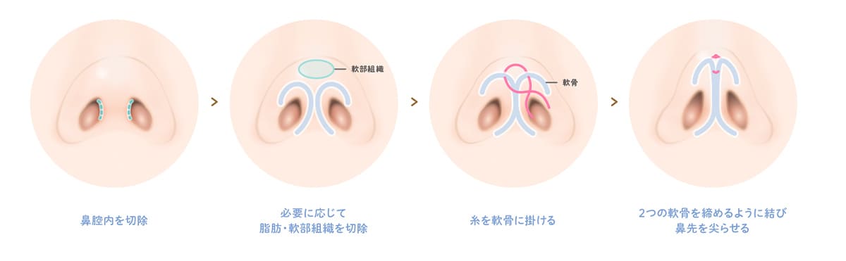 鼻尖形成術