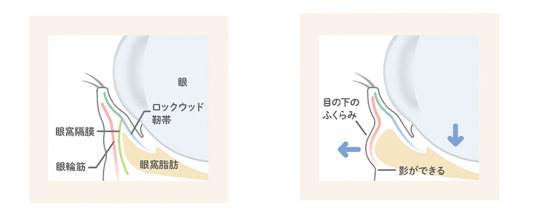 目の下のふくらみの原因