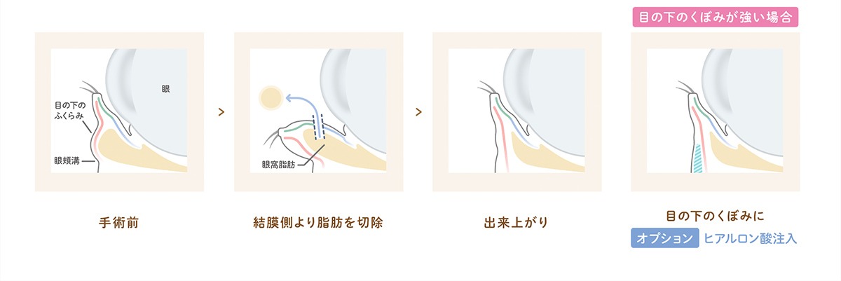 断面図（経結膜脱脂術）