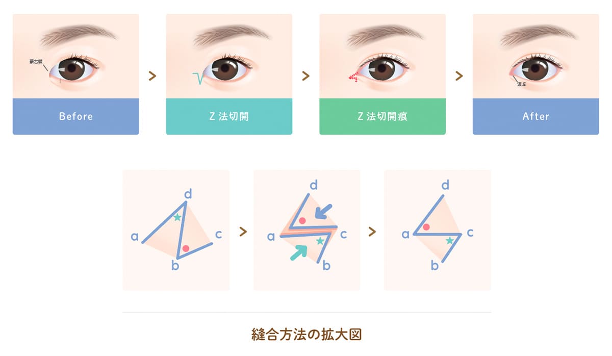 目頭切開手術