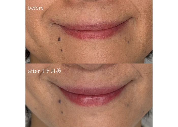 ボトックス 口角