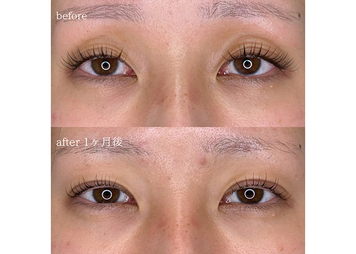 二重埋没法 VSCライン留め4点