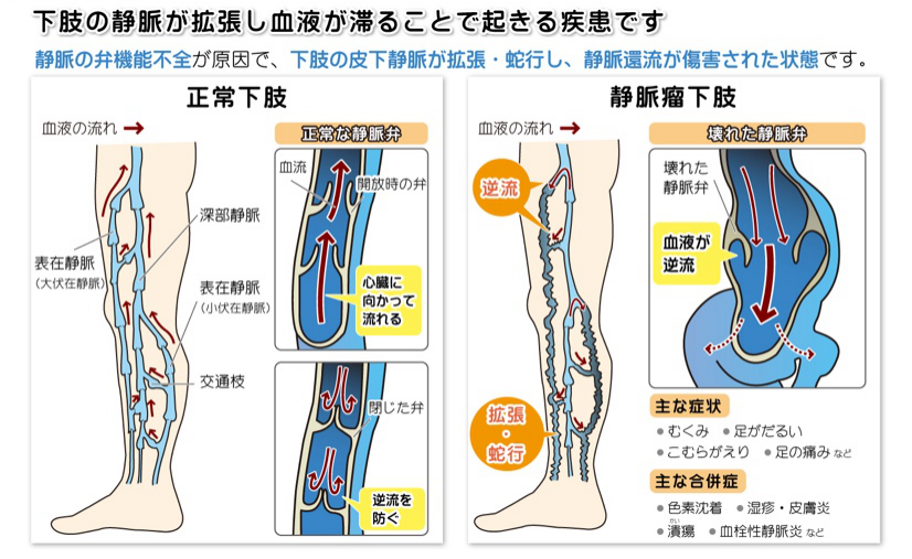 下肢静脈瘤の原因