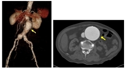 　腹部大動脈瘤のCT画像
